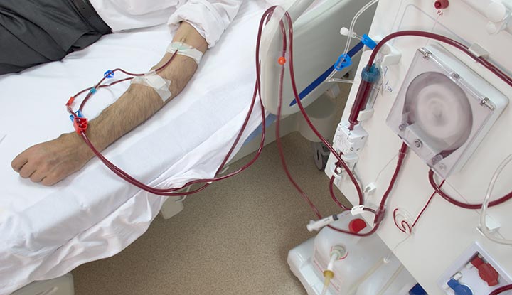 همودیالیز چیست و چه زمانی به پیوند کلیه فکر کنیم؟